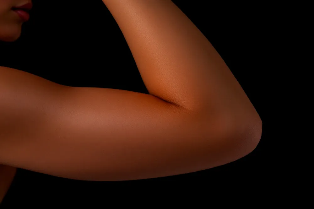 FlexSculpt® arms – before and after upper arm fat removal results